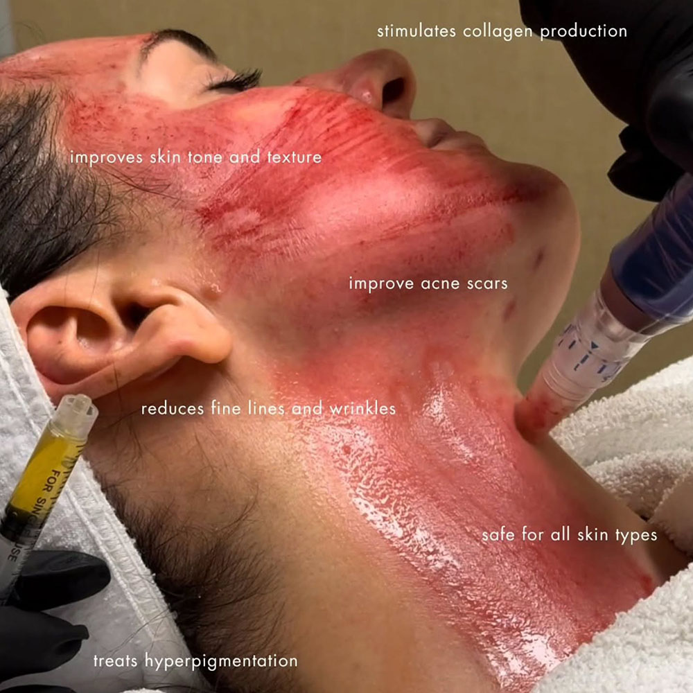 Microneedling With Exosome AD