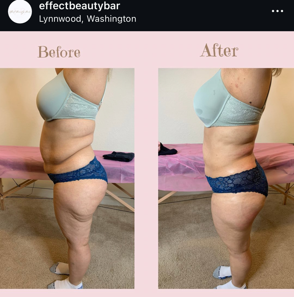 Body Sculpting x6 sessions