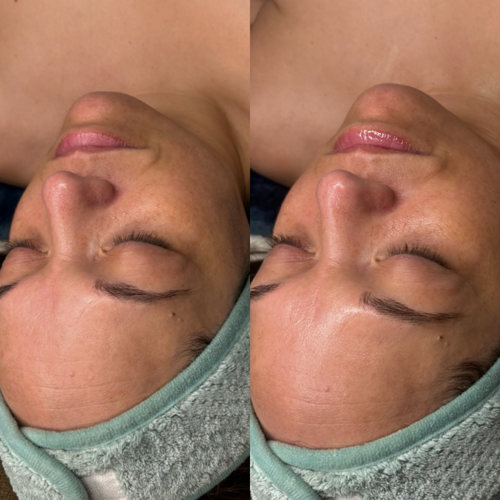 Carboxy Co2 Facial