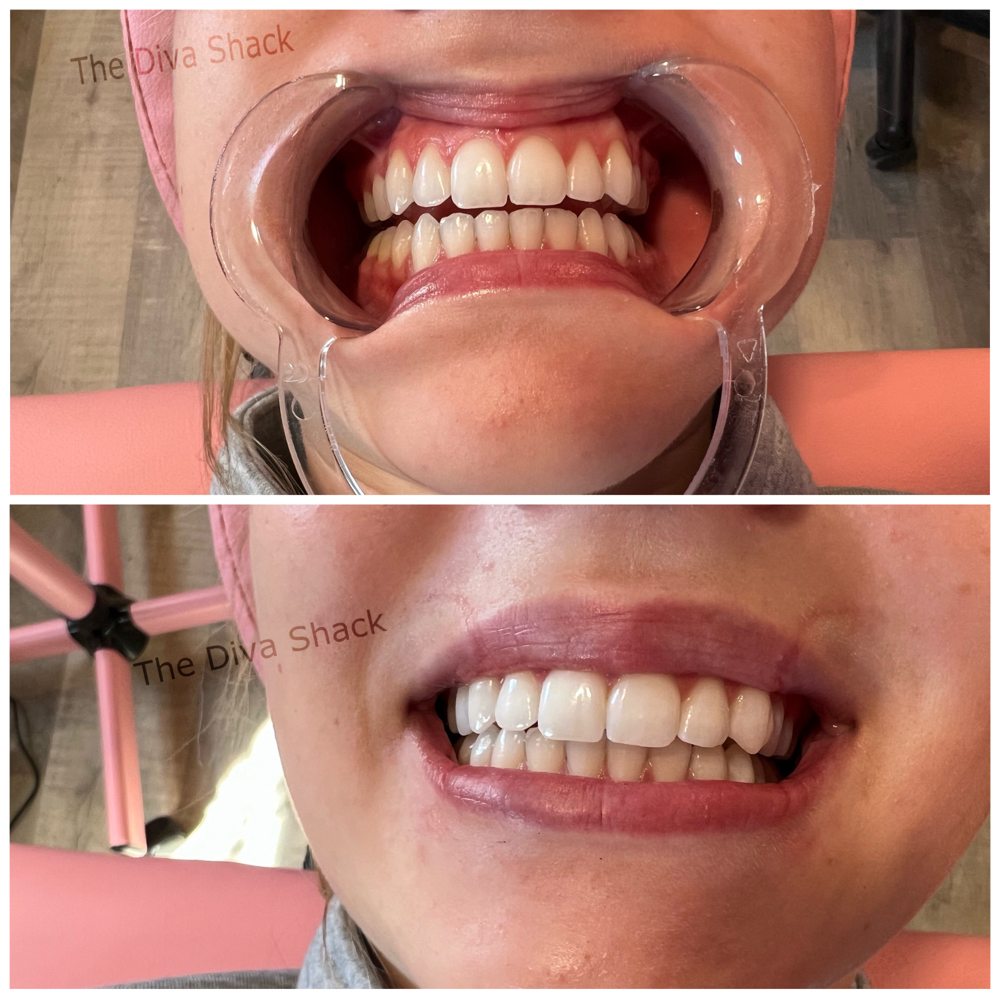 Teeth Whitening