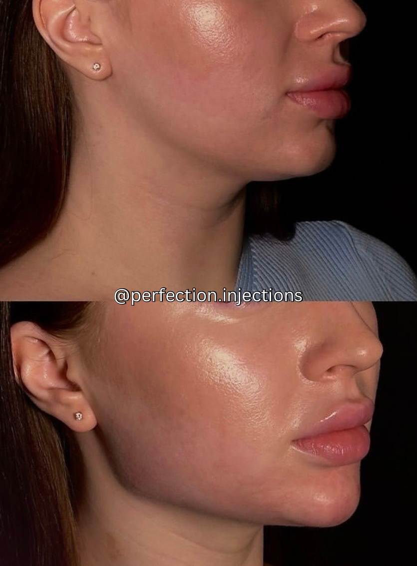 Jawline Filler at Perfection Injections in Euless, TX