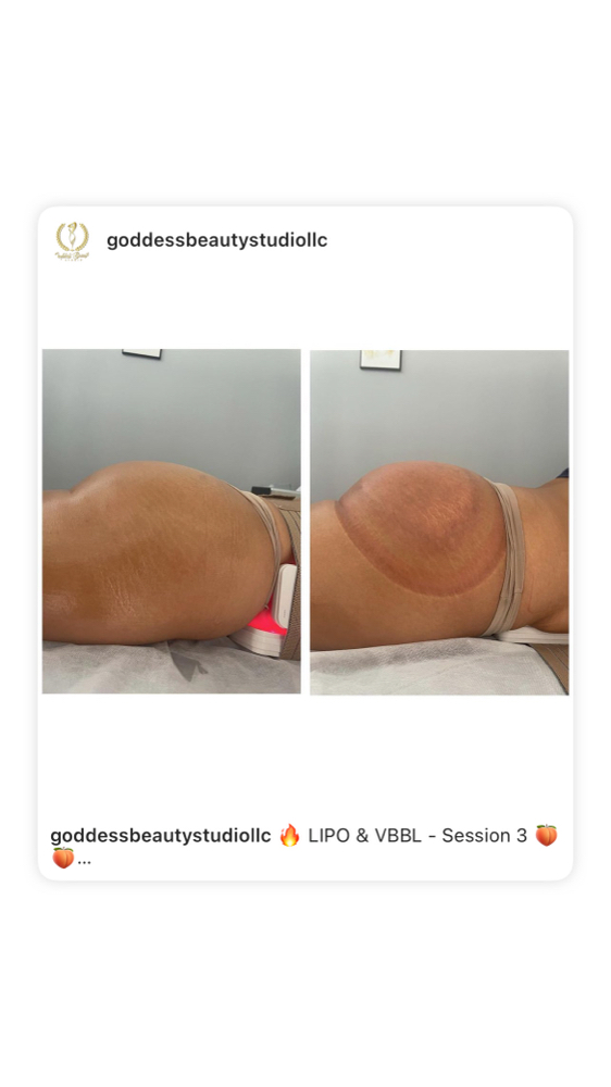 Vacuum BBL at Goddess Beauty Studio in Elmwood Park, IL