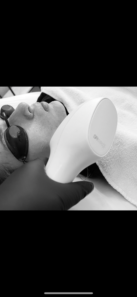 IPL Photorejuvenation/Photofacial