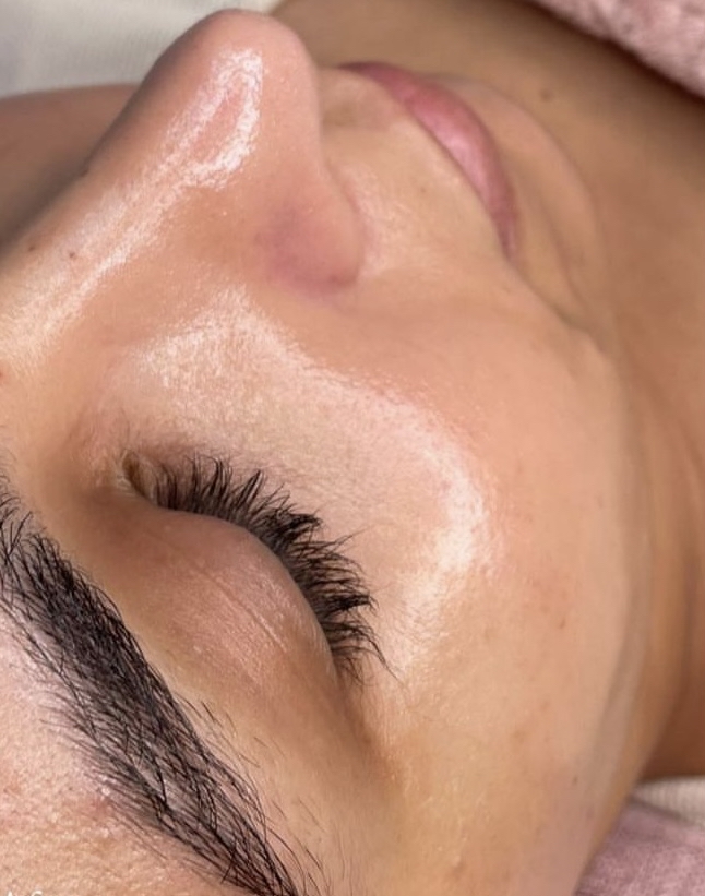 Hydrodermabrasion