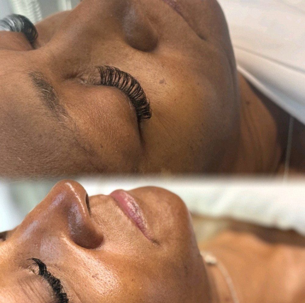 SWiCH Facial, The No-Downtime Peel at Rêvelite Aesthetics in Temecula, CA