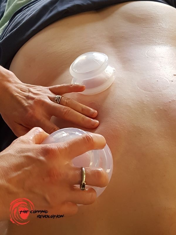 Cupping Massage