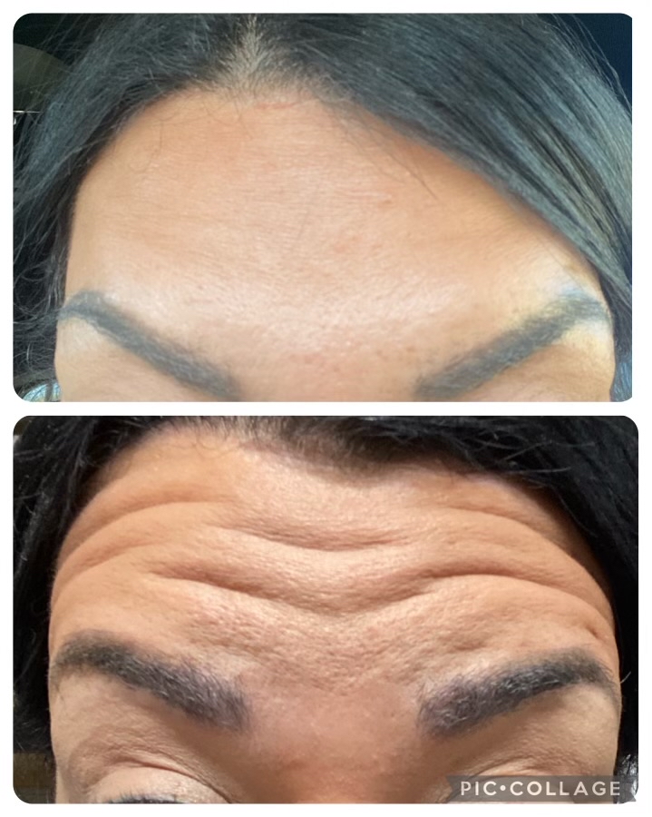 Botox