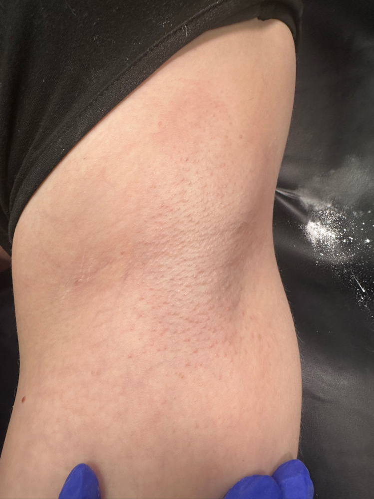 Underarm