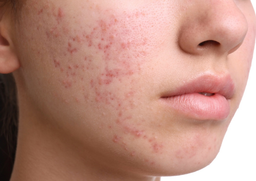 Acne Facial