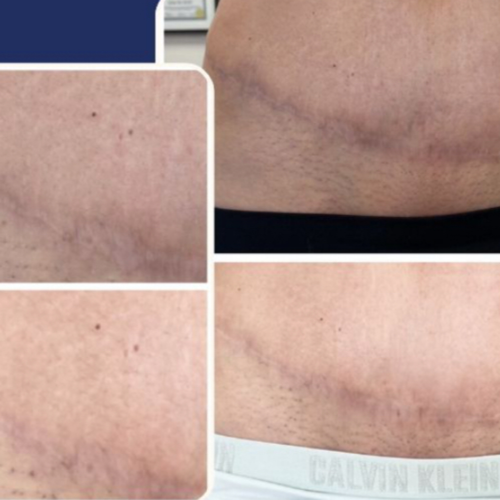 Ink-less Scar Revision at Flourish Skin Artistry in Redding, CA