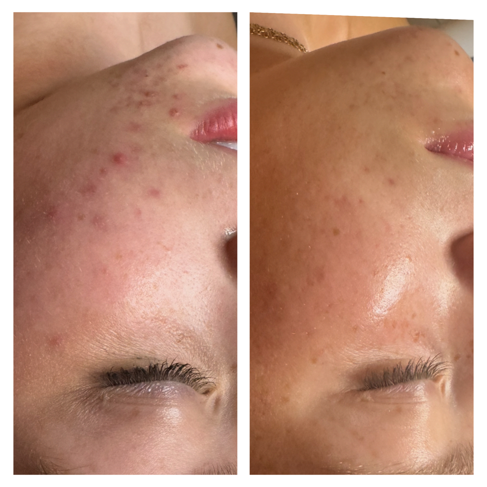 Face Reality Acne Consultation