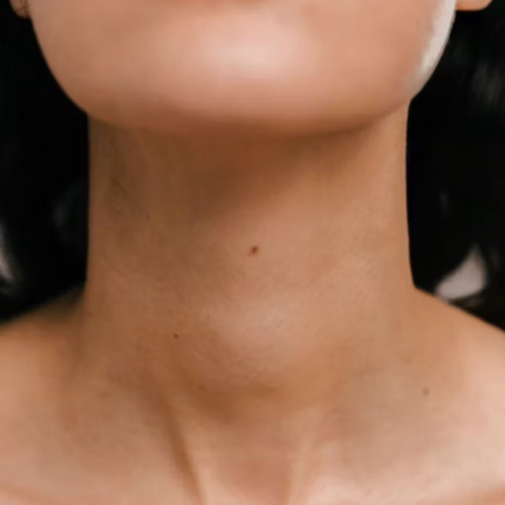 Neck (Front/Back) / 6 Sessions at EverBeauty Laser & Aesthetics in Argyle, TX