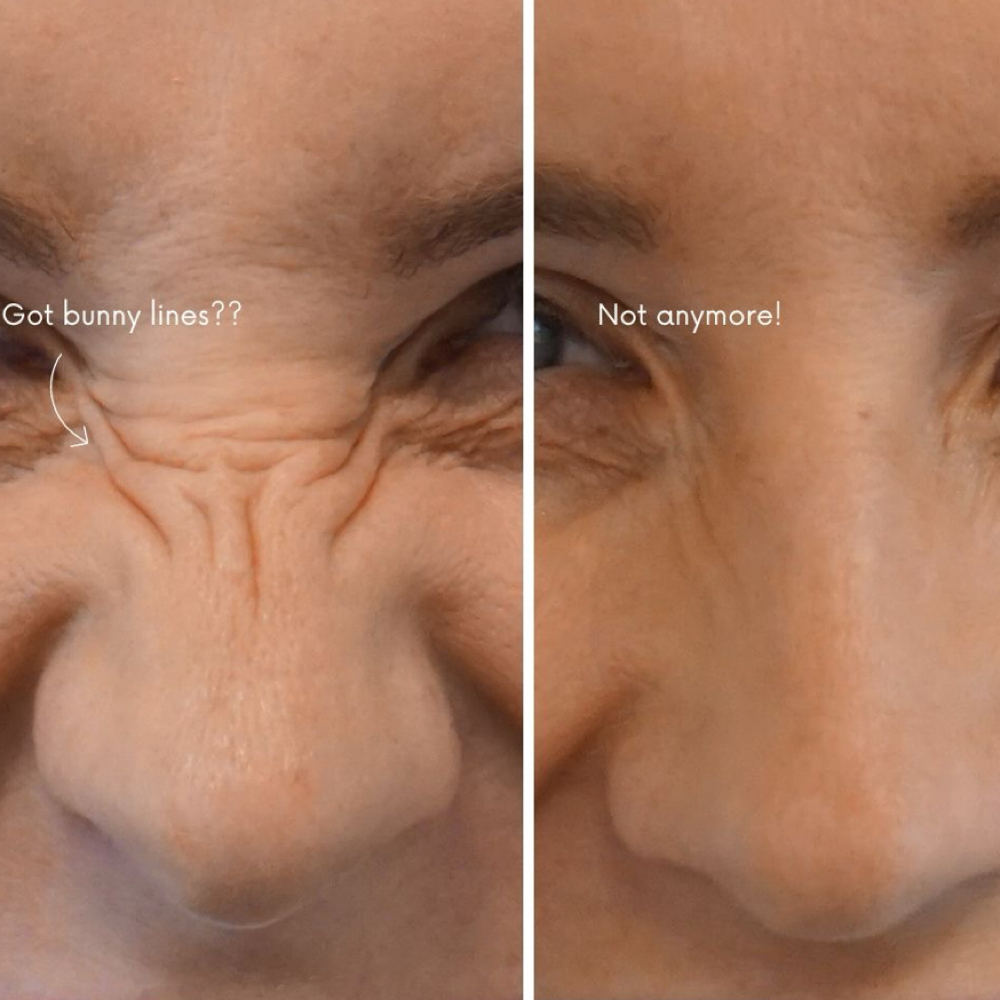 Bunny Lines (Nasalis) at Lilli Aesthetics LLC in Mansfield, TX