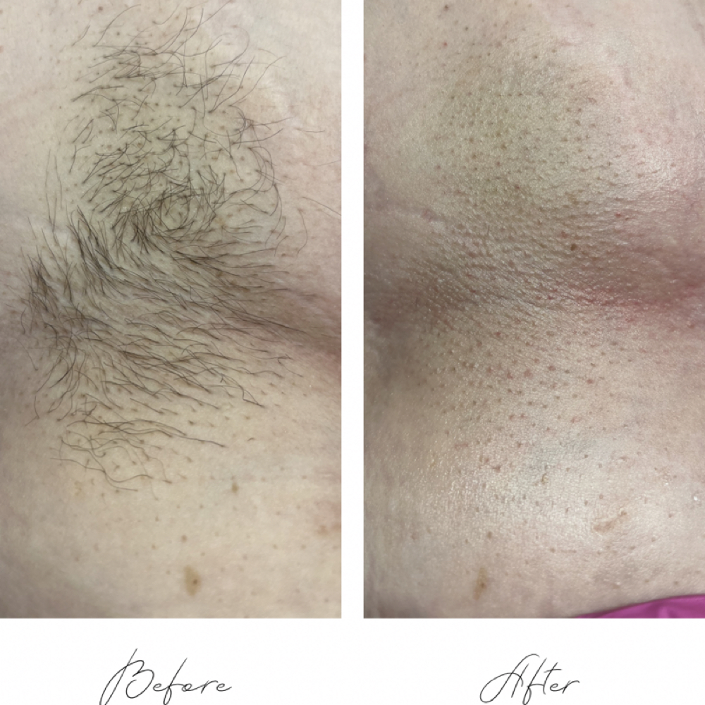 Underarm Wax at In His Image Esthetics in Lincolnton, NC