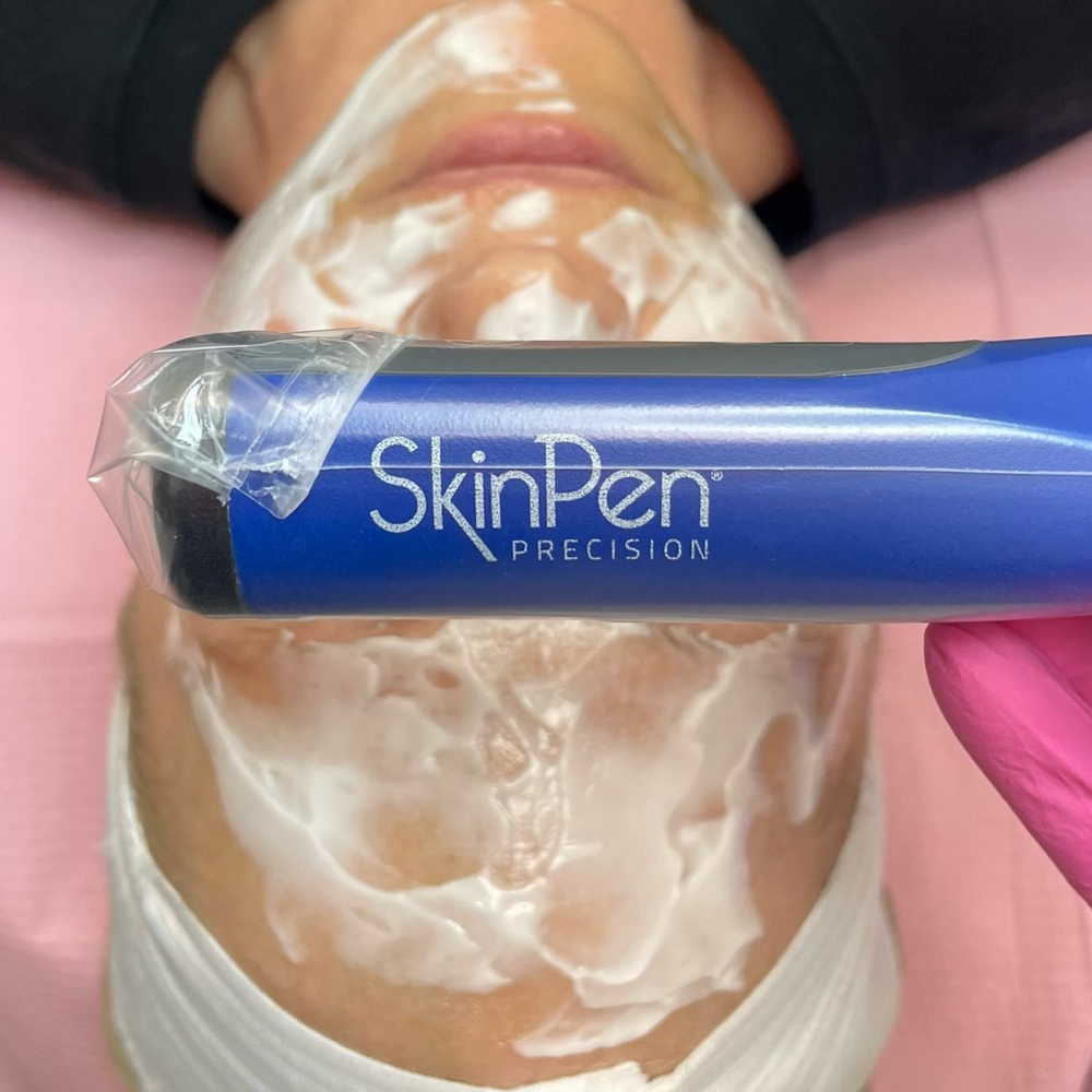 SkinPen Face and FND
