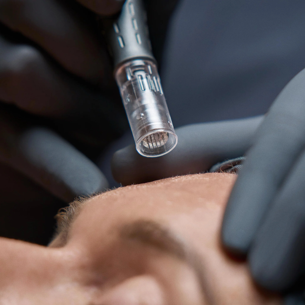 Microneedling Facial at Alyvia Aesthetics in Shawnee, OK