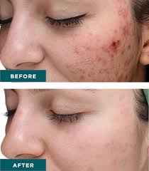 purify VI Chemical Peel