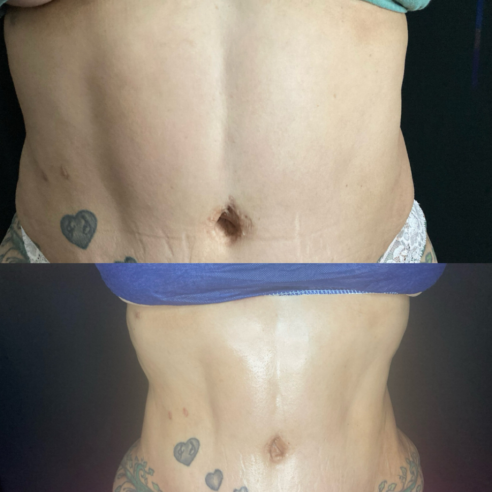 3 Cavitation Sessions at Glo’s Beauty Creations