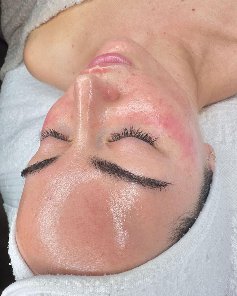Hydrating Elite Treatment (peel) at Reborn beauty spa in Beverly, MA