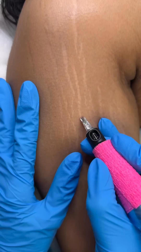 Scar Camouflage (1 session)