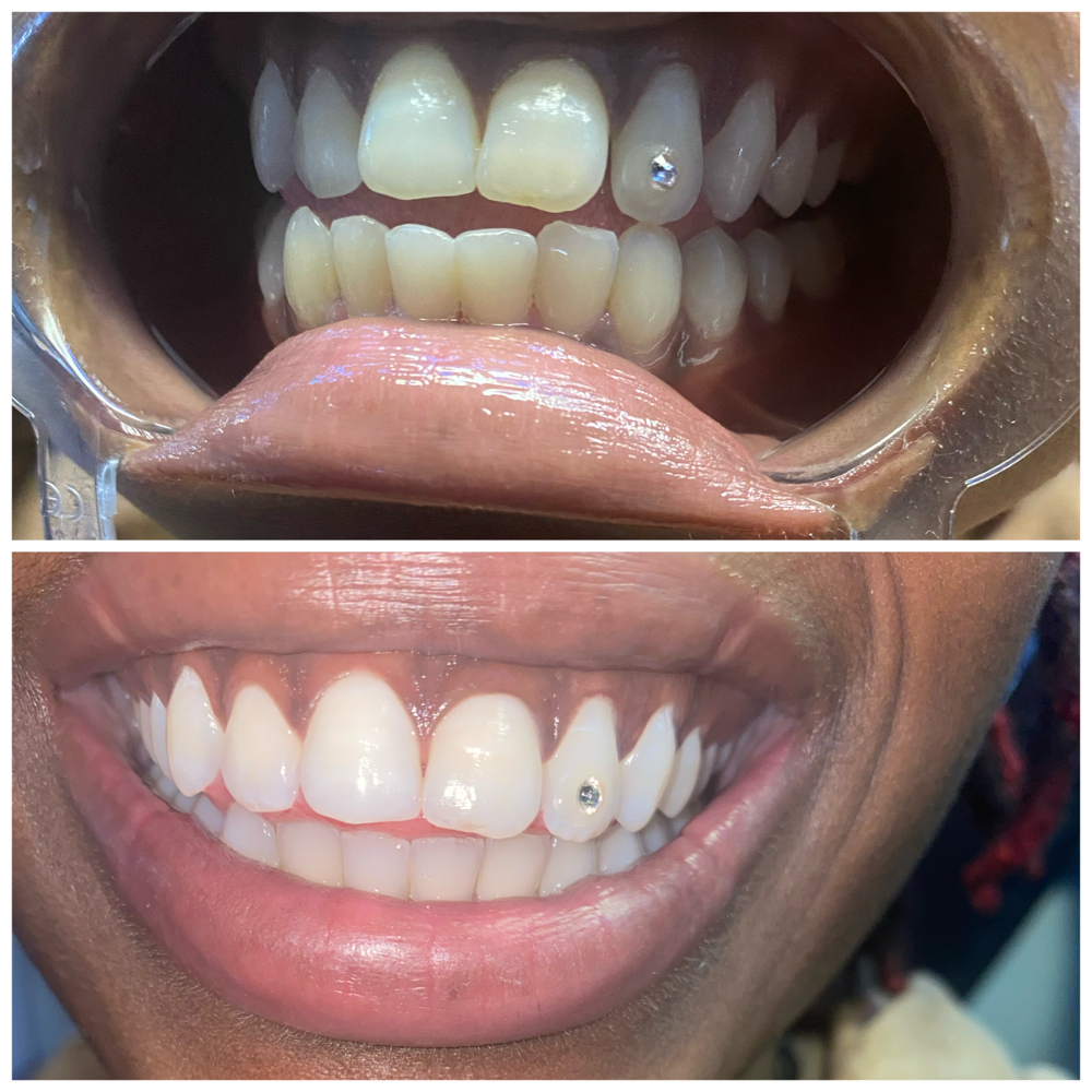 Single Gem at Shaqs Teeth Whitening in Tarboro, NC