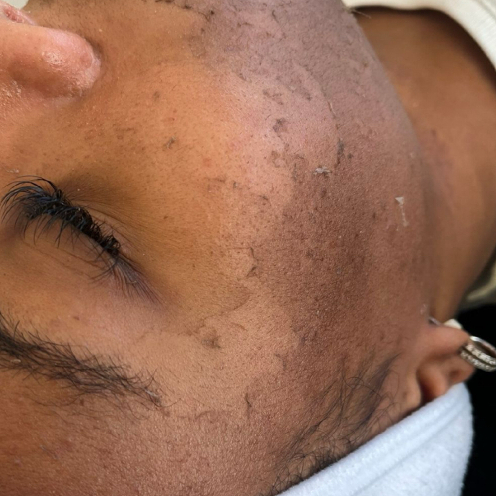The Resurfacing Peel / TCA at ComplexionbyCali in South Jordan, UT
