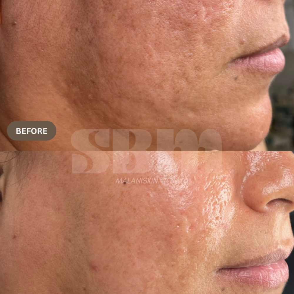 Advanced Custom Facial