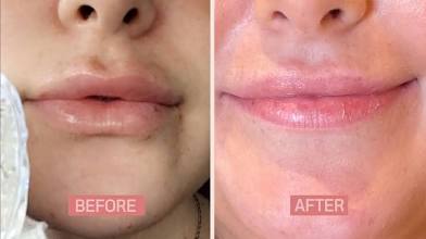 Reversal & Removal of Lip Filler