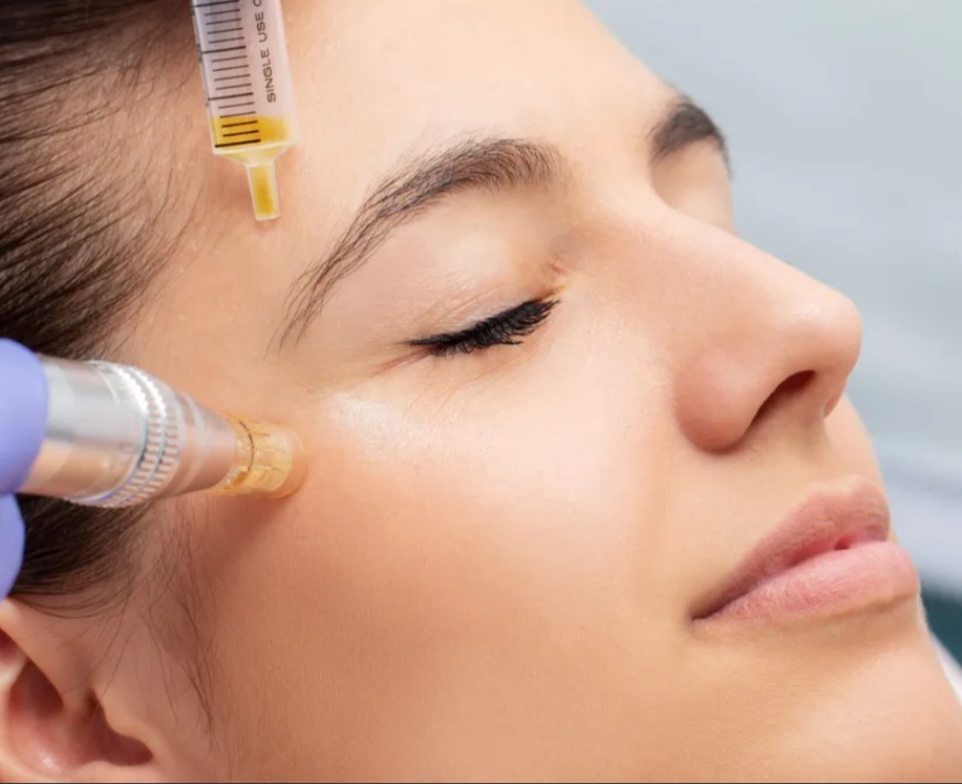 Microneedling P.R.P.