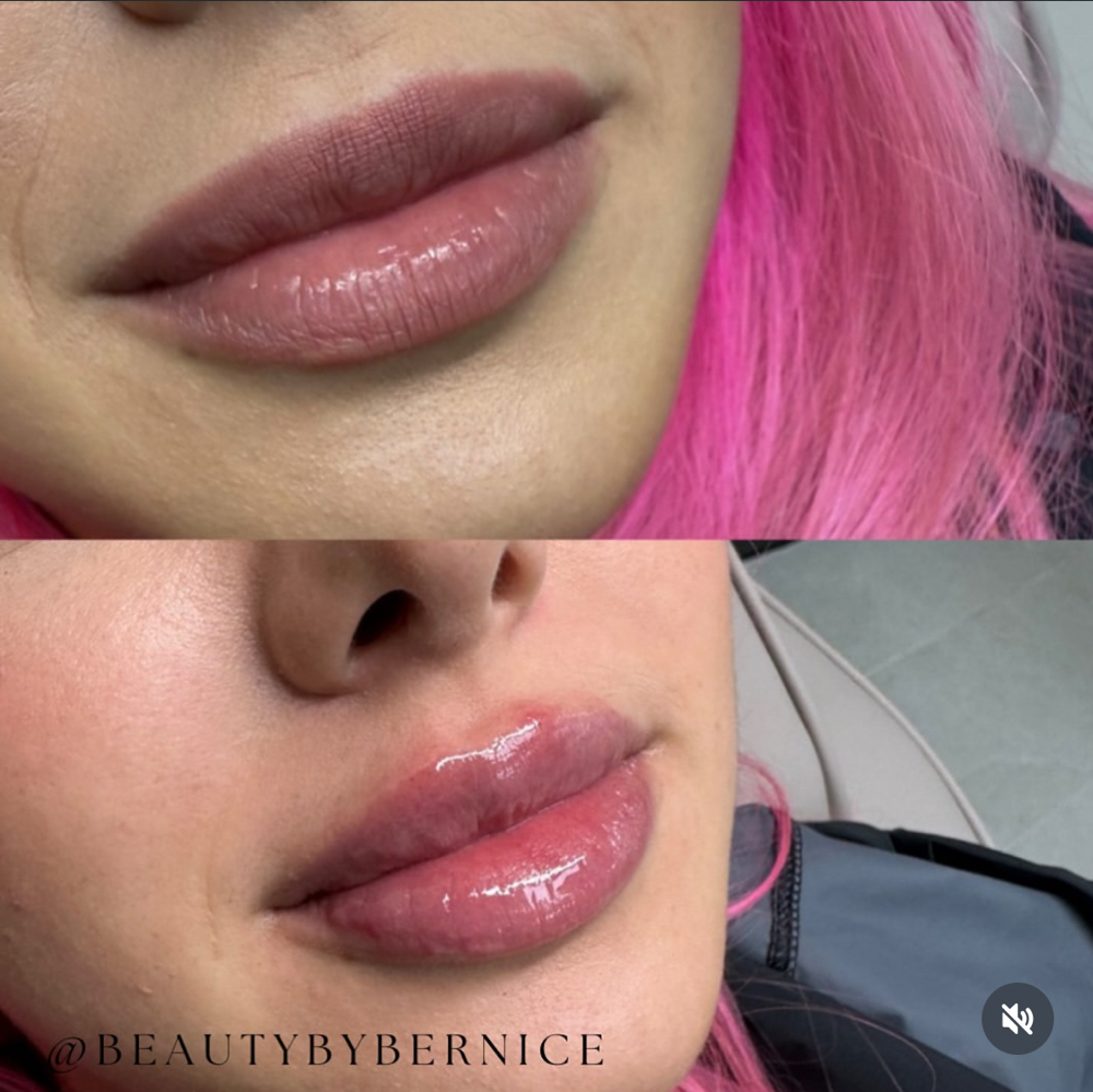 Lip Filler๐๐ at BeautyByBernice in San Antonio, TX