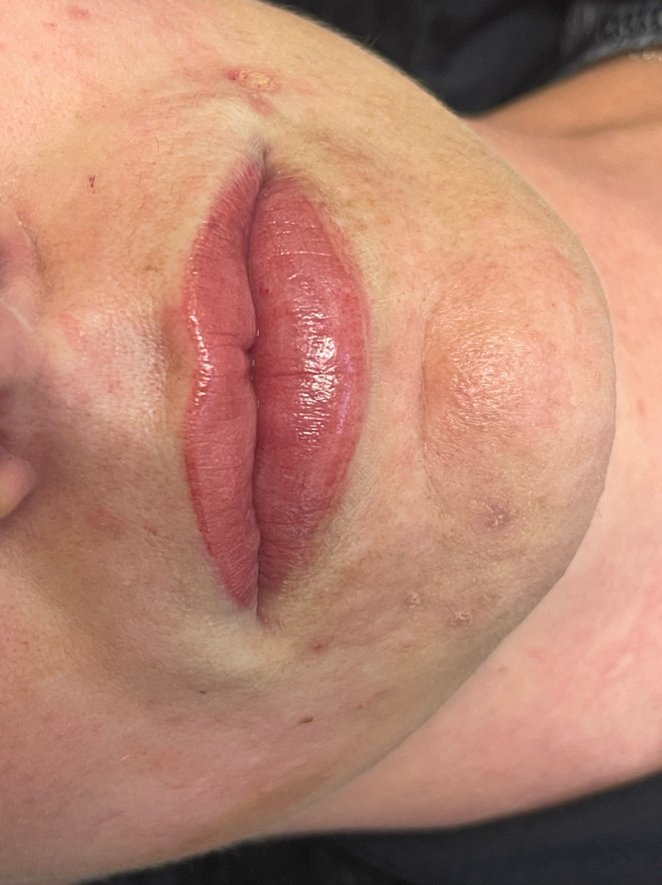 6-10 Week Follow Up LIPS