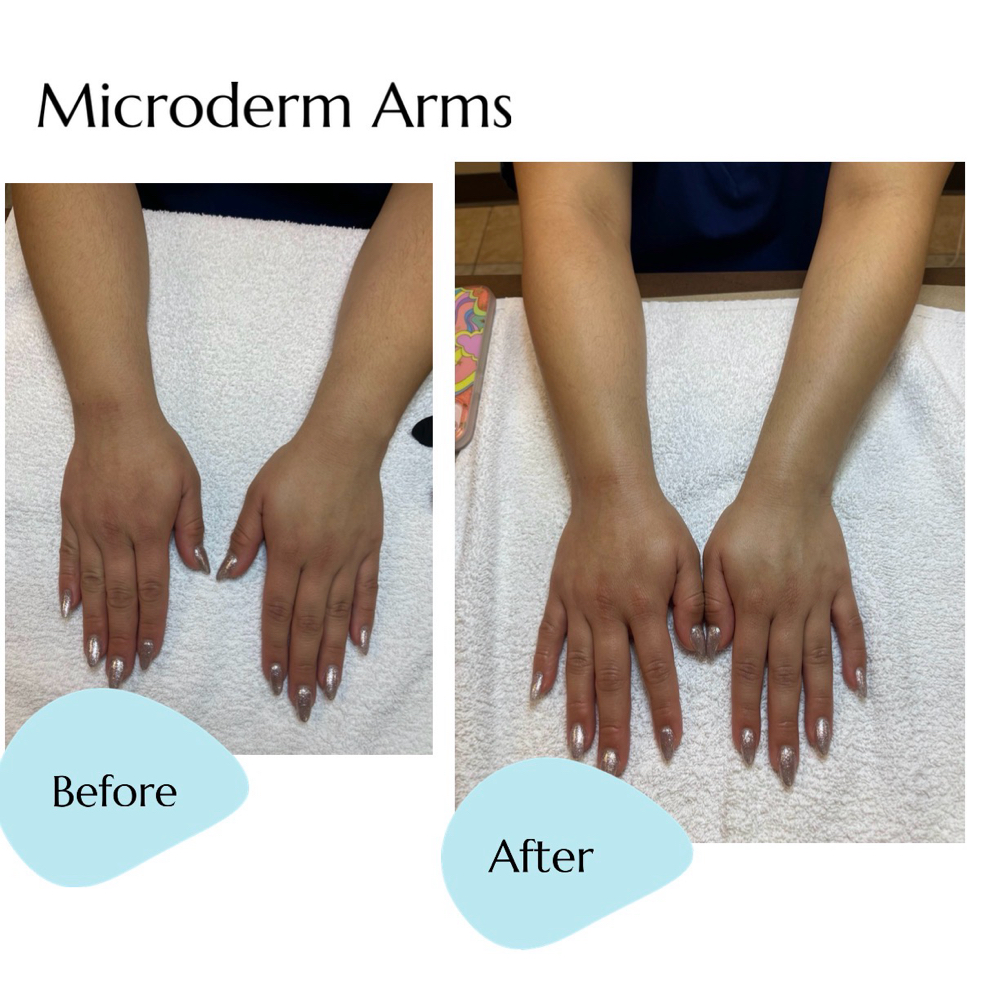 Microderm Arms