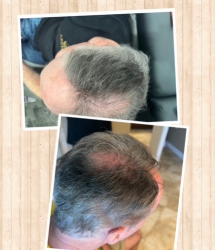 T-Grow Hair Restoration