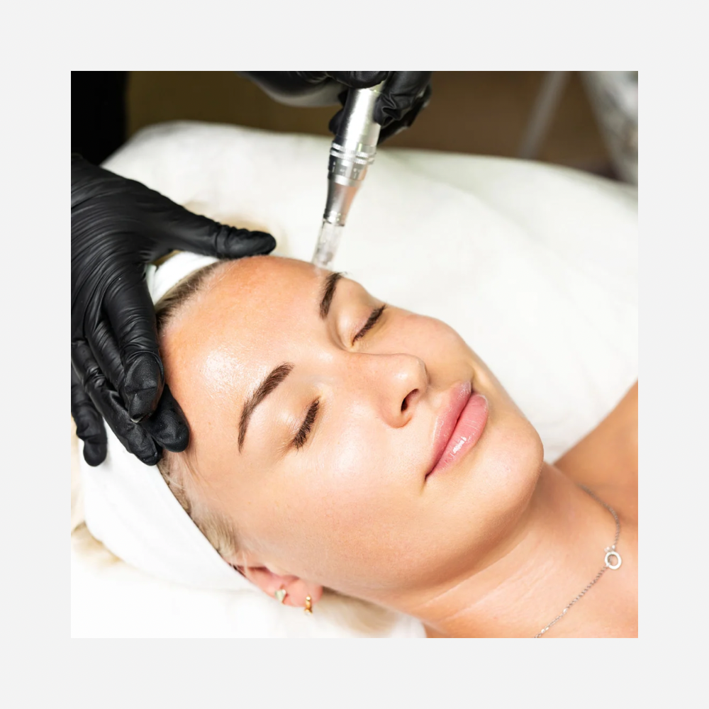 Microneedling with stem cells