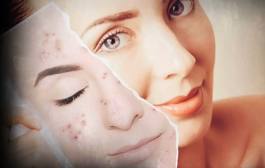 Purifying acne facial