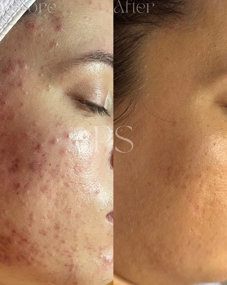 Acne Bootcamp Follow Up Treatments