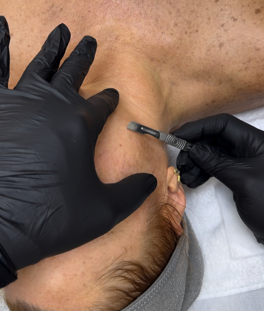Add On Dermaplaning