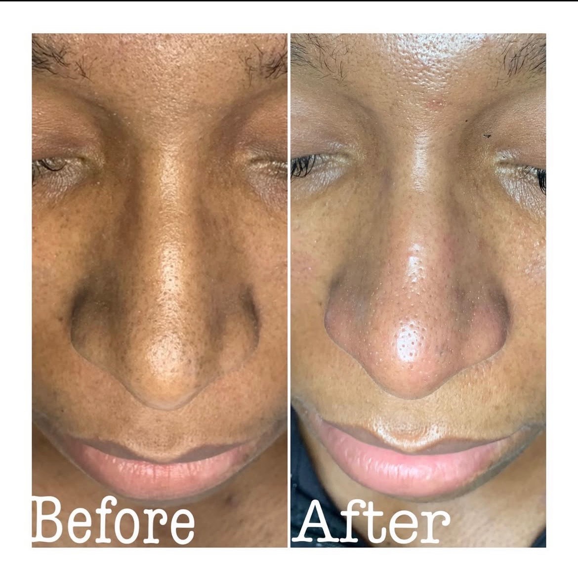 Teen Facial