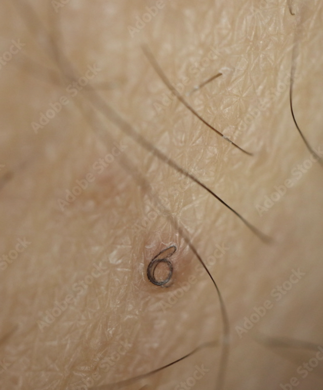 Ingrown Hair Removal