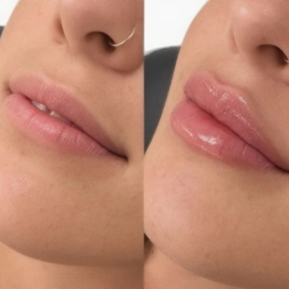 Lip Filler at Vivid Drips & Beauty Bar in Houston, TX