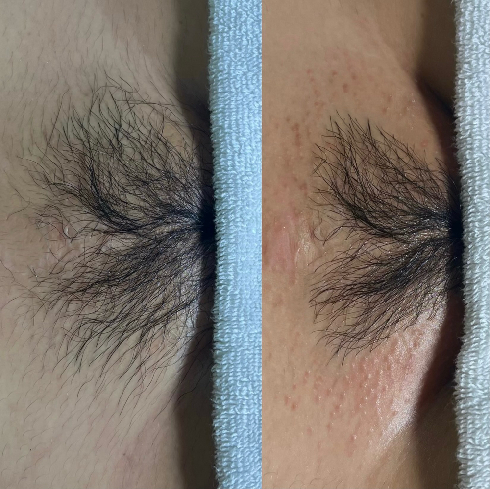 Bikini Waxes