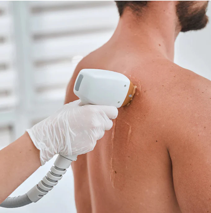 Laser Hair Removal: Back Or Stomach