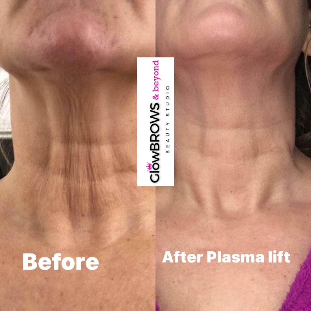 NECK Lift & Rejuvenate by Plasma