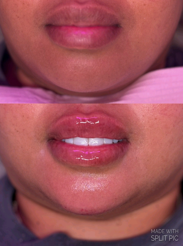 Facial Balancing- Chin