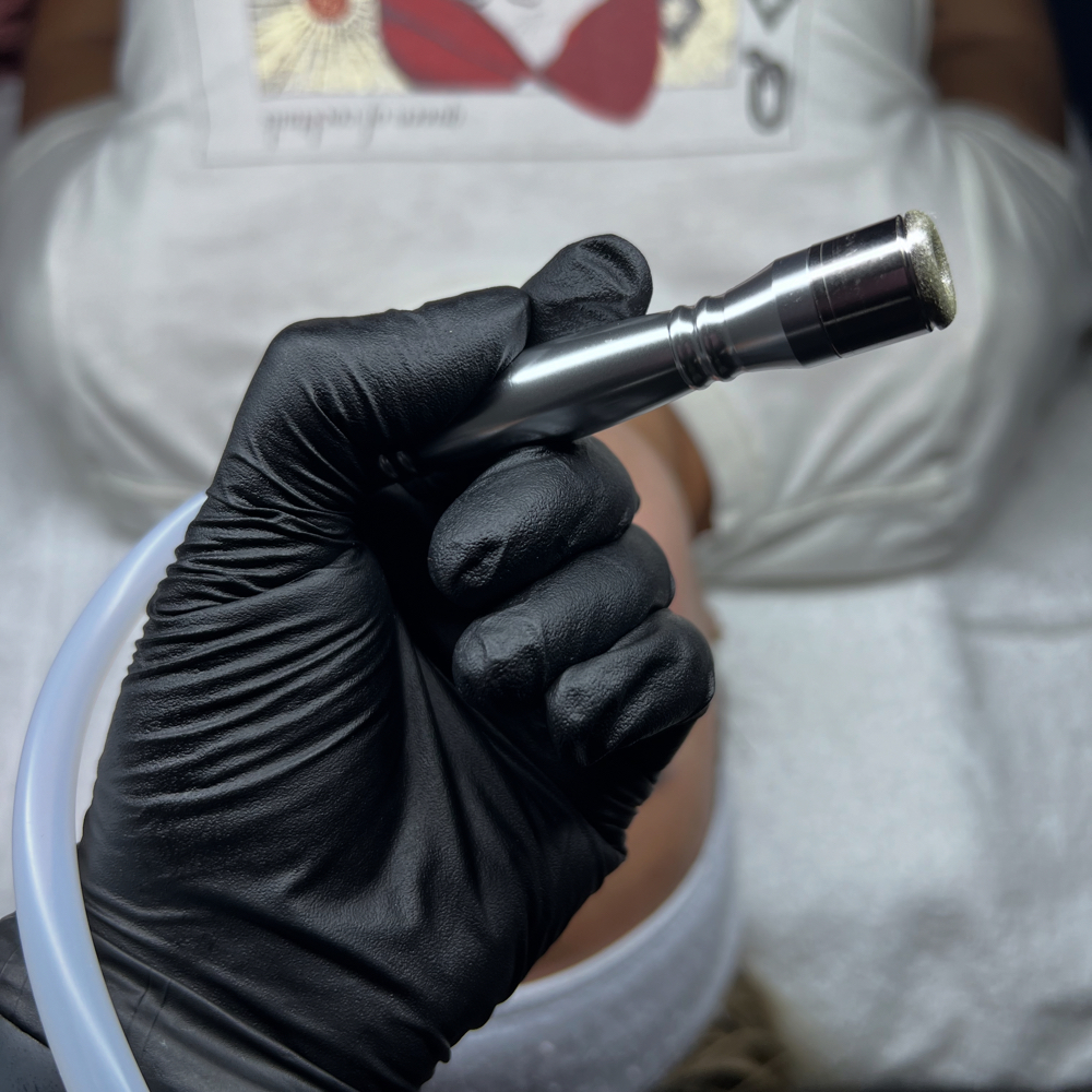 Microdermabrasion Facial