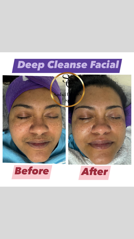 DEEP RENEWAL SKIN TREATMENT