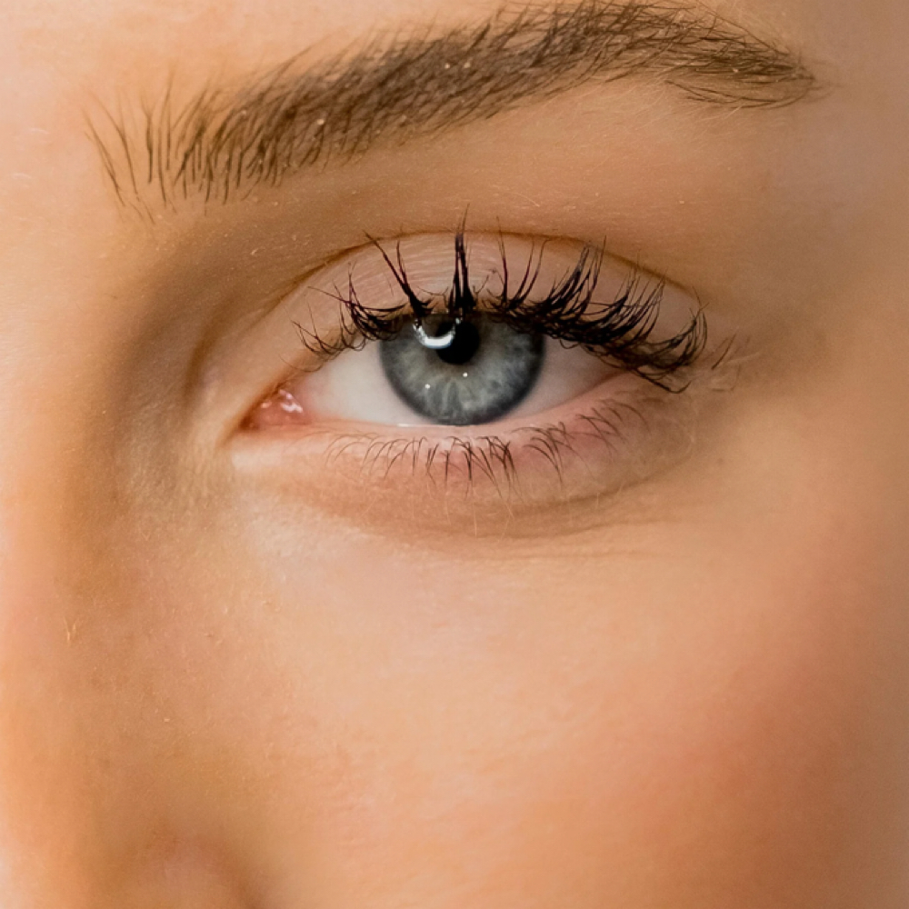Under Eye PRF at Radiating Aesthetics in Saline, MI
