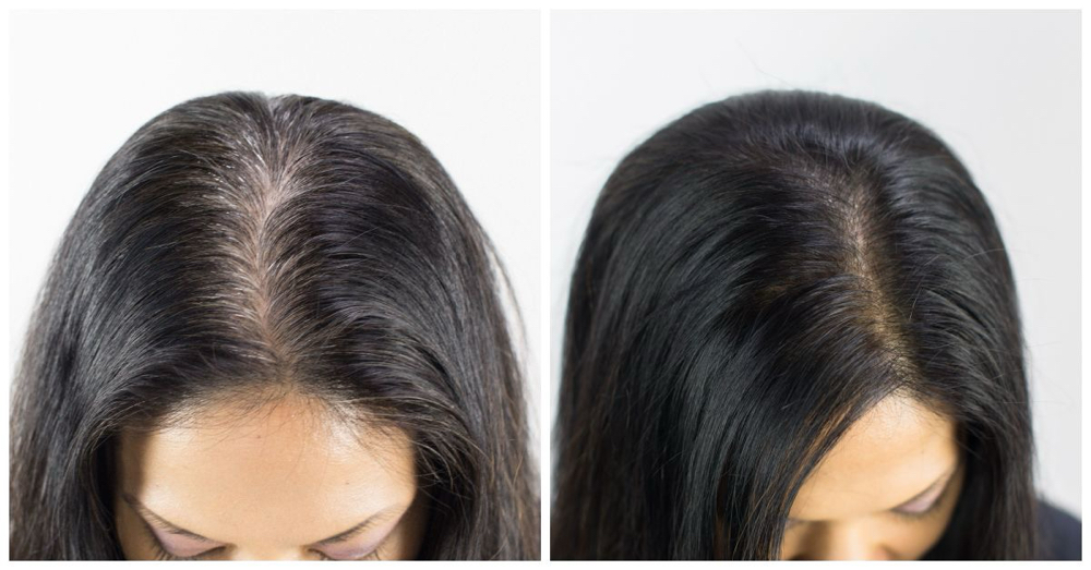 Root Retouch