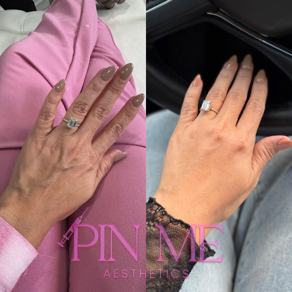 Hand Rejuvenation at Pin Me Aesthetics PLLC in Alvin, TX