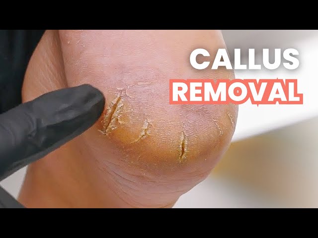 Callus Removal